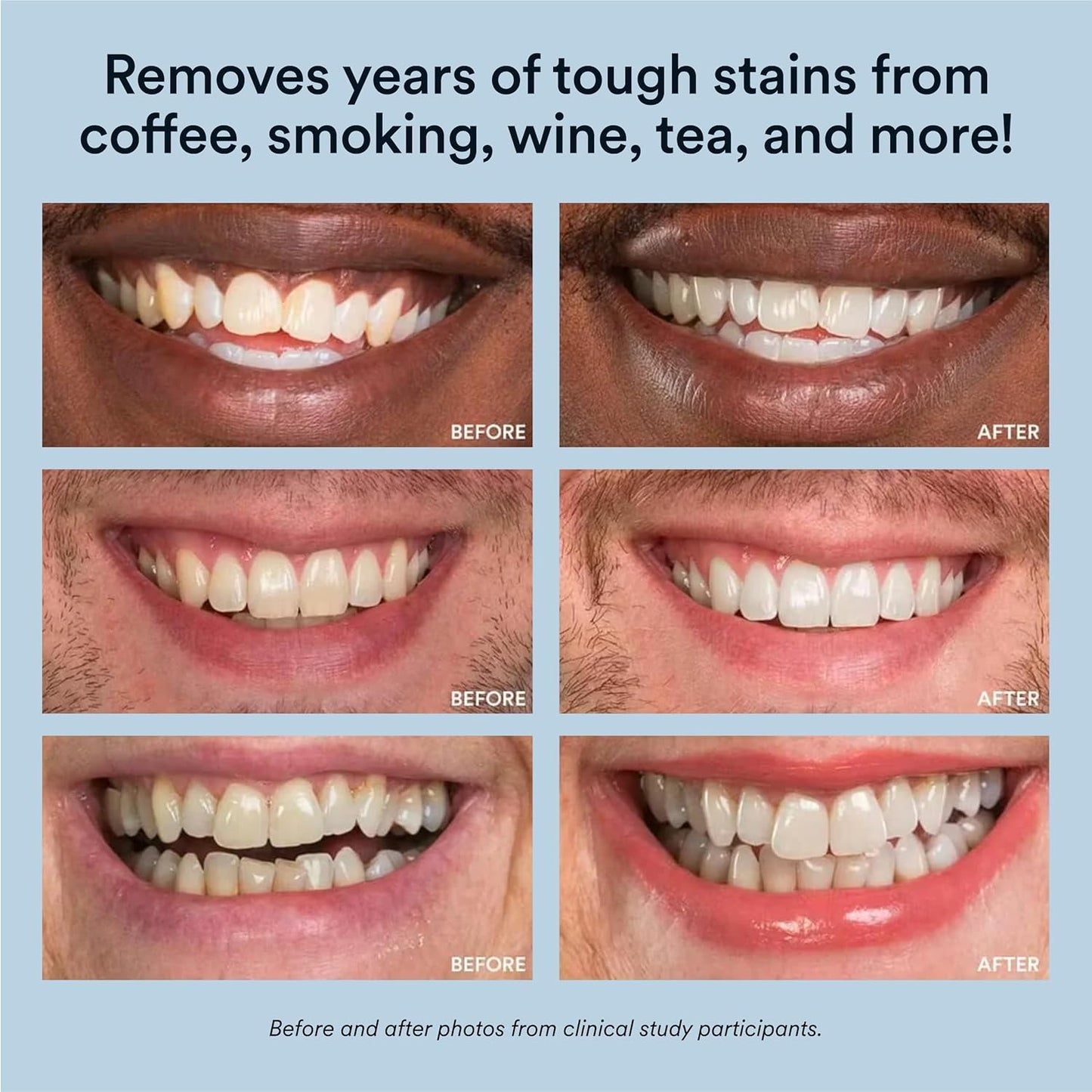 Auraglow Teeth Whitening Kit with LED Light | 35% Carbamide Peroxide Gel | Whitens Up to 10 Shades in 7 Days | 20+ Treatments