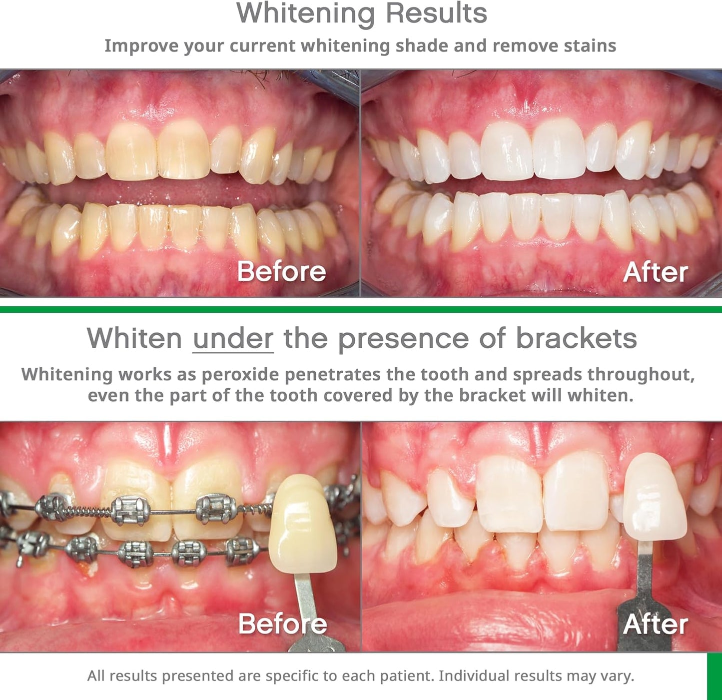 Opalescence Go 15% Prefilled Teeth Whitening Trays | Mint | Ready-to-Use Whitening Kit | 10 Professional Treatments | Made by Ultradent