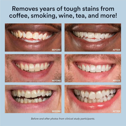 Auraglow Teeth Whitening Kit with LED Light | 35% Carbamide Peroxide Gel | Whitens Up to 10 Shades in 7 Days | 20+ Treatments